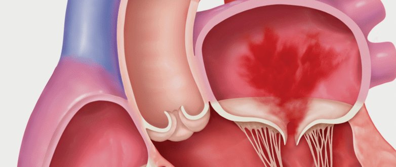 secondary-mitral-regurgitation